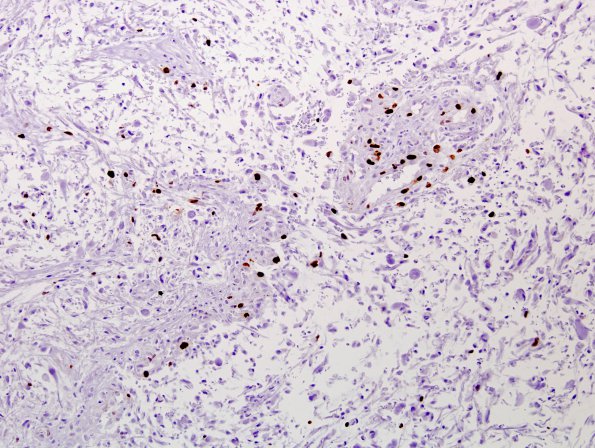 37B Astrocytoma, pilocytic (Case 37) MIB-1 2