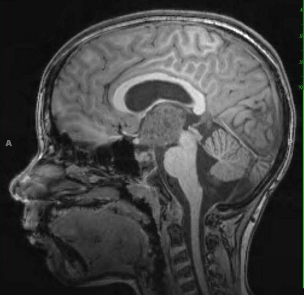 38A1 Astrocytoma, pilocytic (Case 38) T1 MPRage - Copy