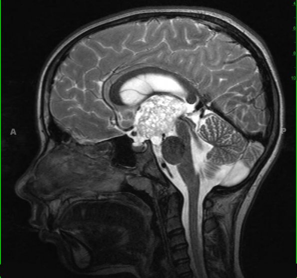 38A2 Astrocytoma, pilocytic (Case 38) T2 W 1 - Copy