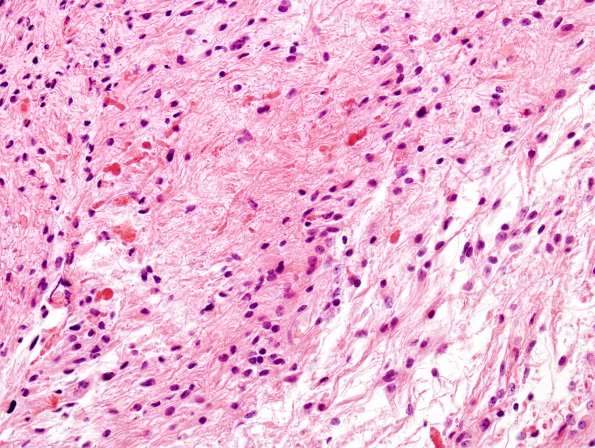 38B Astrocytoma, pilocytic (Case 38) 7