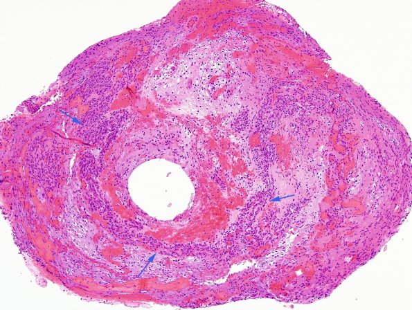 39A1 Astrocytoma, pilocytic (Case 39) H&E 2 copy