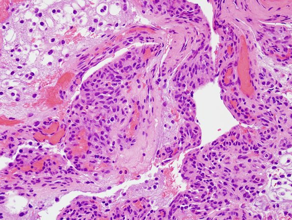 39A2 Astrocytoma, pilocytic (Case 39) H&E 1