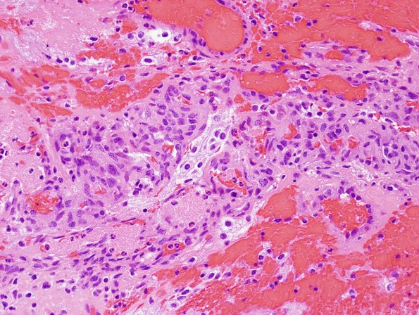 39A3 Astrocytoma, pilocytic (Case 39) H&E 4