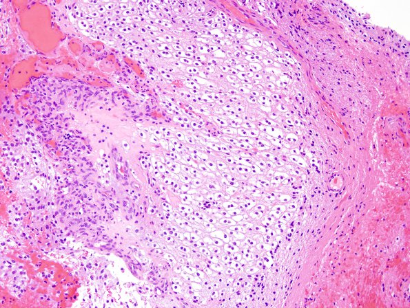 39A4 Astrocytoma, pilocytic spinal (Case 39) H&E 2