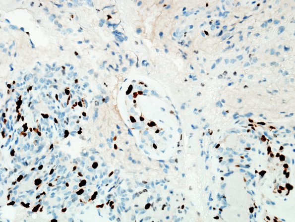 39B2 Astrocytoma, pilocytic (Case 39) Ki67 5