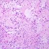 3A1 Astrocytoma, pilocytic (70 yo, Case 3) H&E 7