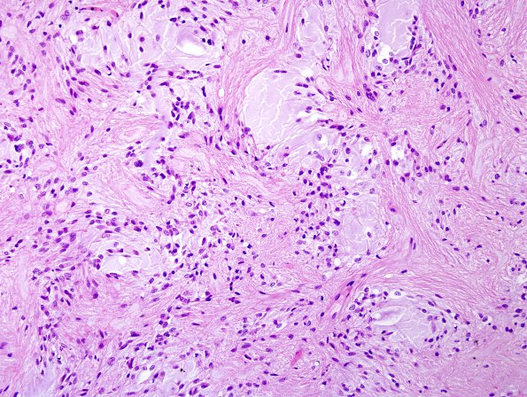 3A1 Astrocytoma, pilocytic (70 yo, Case 3) H&E 7