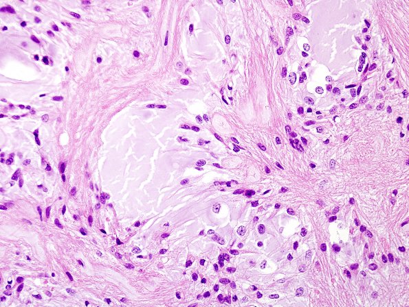 3A2 Astrocytoma, pilocytic (70 yo, Case 3) H&E 8