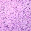 3A3 Astrocytoma, pilocytic (70 yo, Case 3) H&E 4