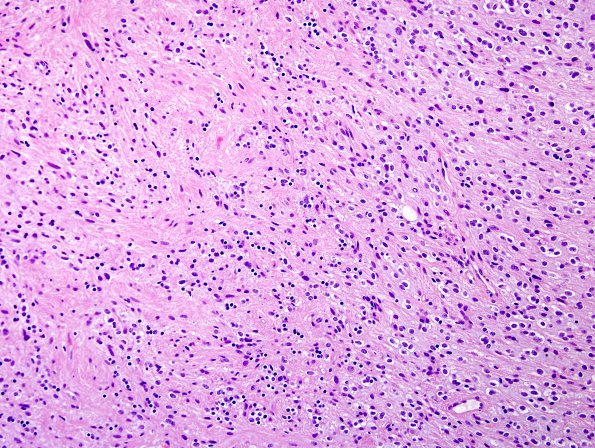 3A3 Astrocytoma, pilocytic (70 yo, Case 3) H&E 4