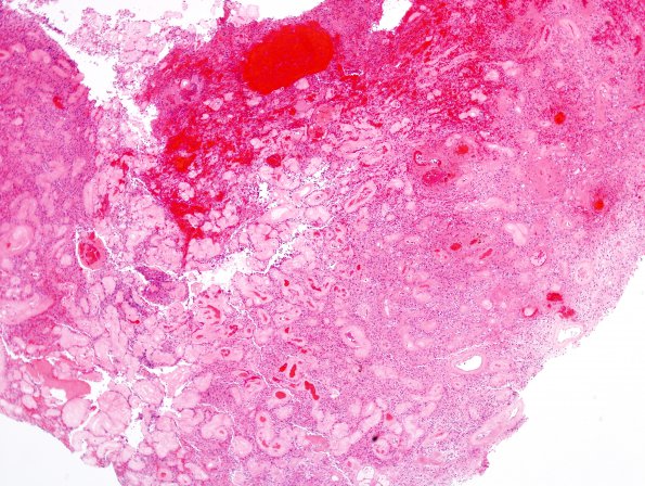 40A1 Astrocytoma, pilocytic (Case 40) H&E 2