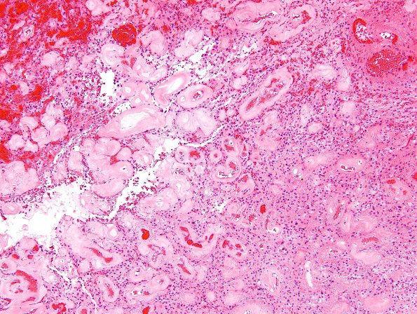 40A2 Astrocytoma, pilocytic (Case 40) H&E 1