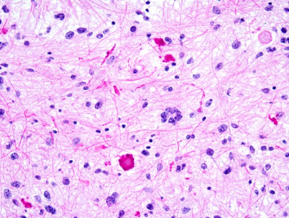 41A1 Astrocytoma, pilocytic (Case 41) 7.j