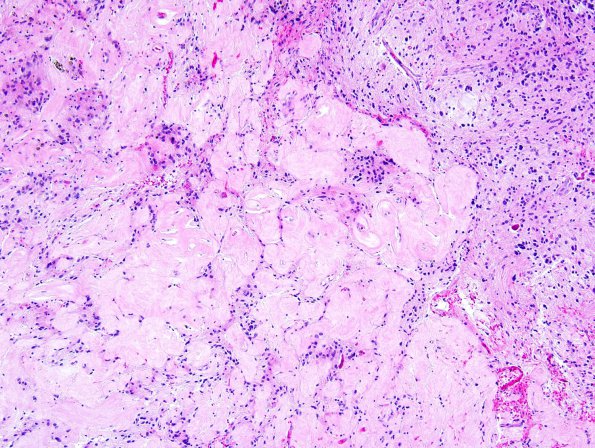 41A2 Astrocytoma, pilocytic (Case 41) 8