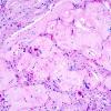 41A3 Astrocytoma, pilocytic (Case 41) 10