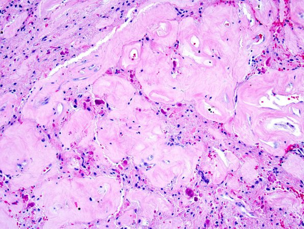 41A3 Astrocytoma, pilocytic (Case 41) 10