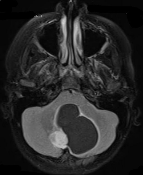 42A1 Astrocytoma, pilocytic (Case 42) FLAIR - Copy