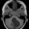 42A2 Astrocytoma, pilocytic (Case 42) T1 - Copy