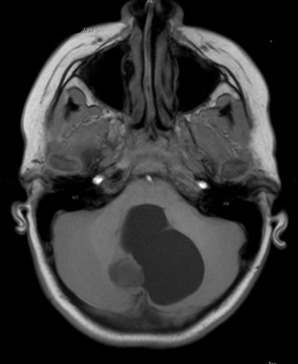 42A2 Astrocytoma, pilocytic (Case 42) T1 - Copy