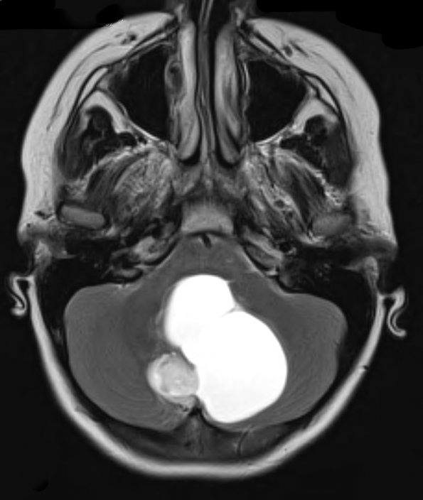 42A3 Astrocytoma, pilocytic (Case 42) T2 - Copy