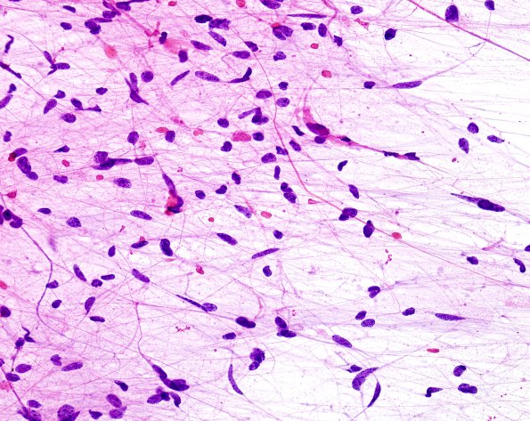 42B1 Astrocytoma, pilocytic (Case 42) H&E Smear 2 - Copy