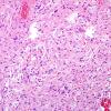 42B2 Astrocytoma, pilocytic (Case 42) H&E 6