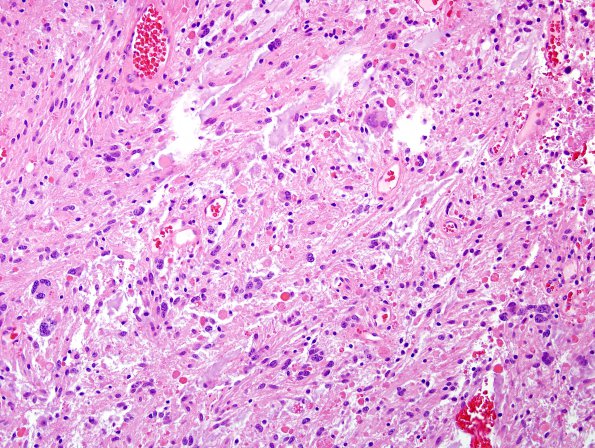 42B2 Astrocytoma, pilocytic (Case 42) H&E 6