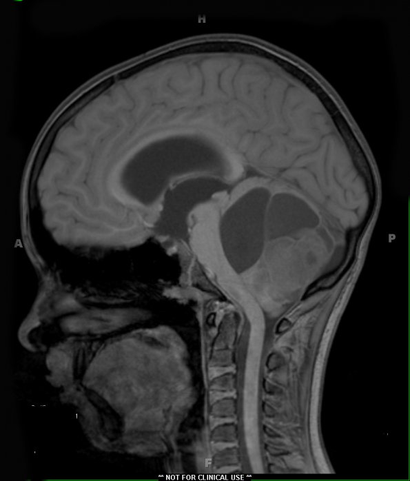 43A1 Astrocytoma, pilocytic (Case 43) T1 - Copy