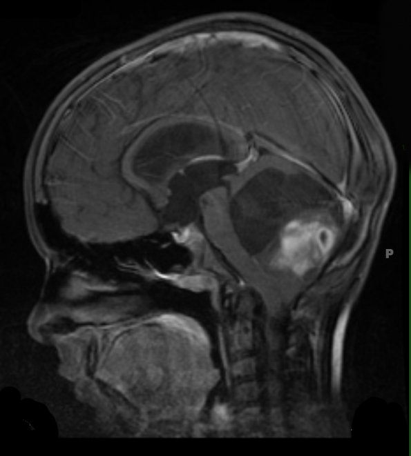 43A2 Astrocytoma, pilocytic (Case 43) T1 W - Copy