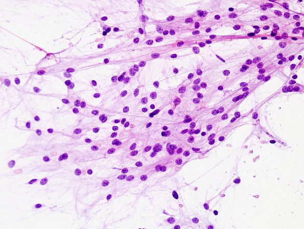 43B1 Astrocytoma, pilocytic (Case 43) smear H&E 1