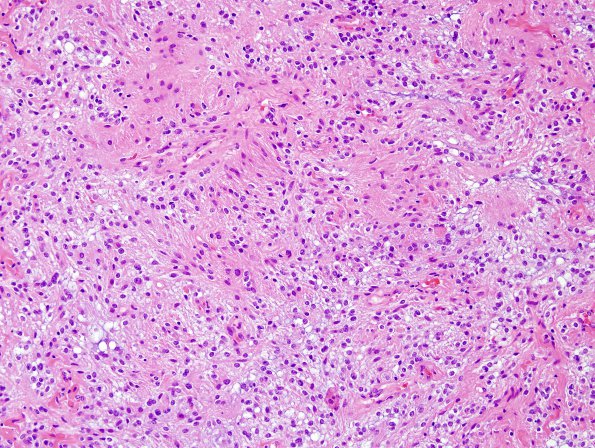 43B2 Astrocytoma, pilocytic (Case 43) H&E 5