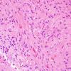 43B3 Astrocytoma, pilocytic (Case 43) H&E 3