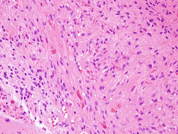 43B3 Astrocytoma, pilocytic (Case 43) H&E 3