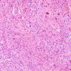 43B4 Astrocytoma, pilocytic (Case 43) H&E 4