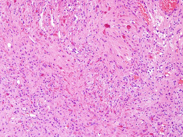 43B4 Astrocytoma, pilocytic (Case 43) H&E 4