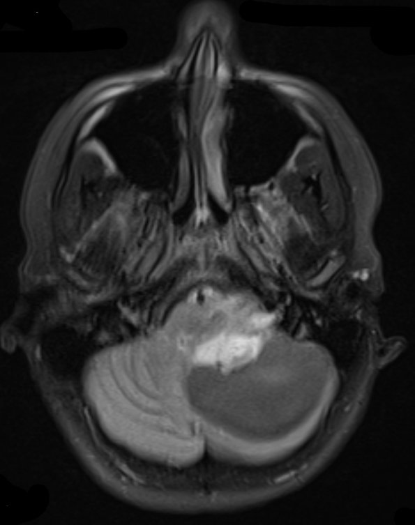 44A1 Astrocytoma, pilocytic (Case 44) FLAIR - Copy