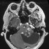 44A2 Astrocytoma, pilocytic (Case 44) T1 MPRAGE W - Copy