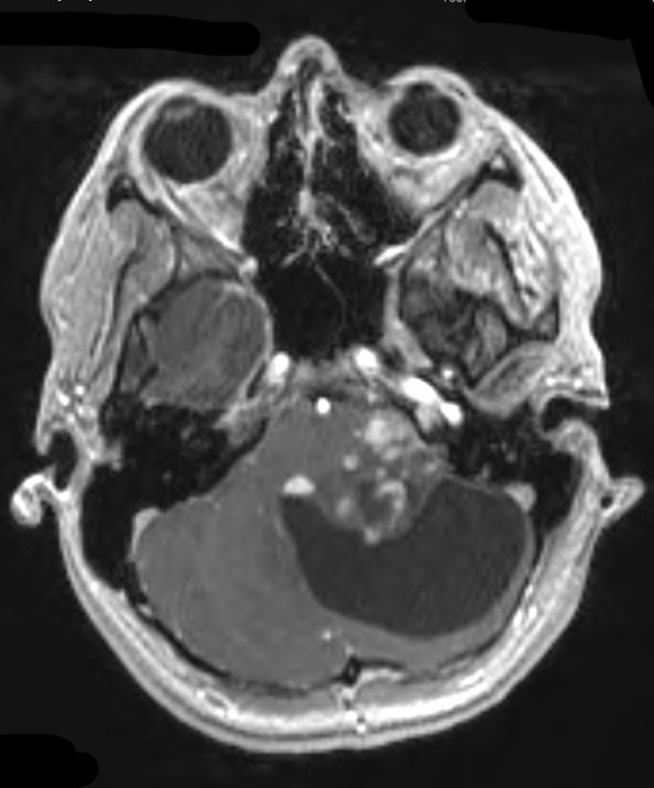 44A2 Astrocytoma, pilocytic (Case 44) T1 MPRAGE W - Copy