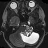 44A3 Astrocytoma, pilocytic Case 44) T2 W - Copy