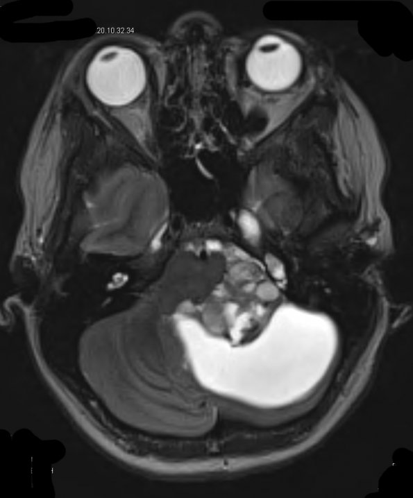 44A3 Astrocytoma, pilocytic Case 44) T2 W - Copy