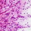 44B1 Astrocytoma, pilocytic (Case 44) Squash Prep H&E 2