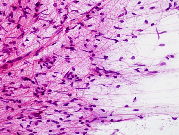 44B1 Astrocytoma, pilocytic (Case 44) Squash Prep H&E 2