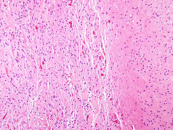 44B2 Astrocytoma, pilocytic (Case 44) H&E 4