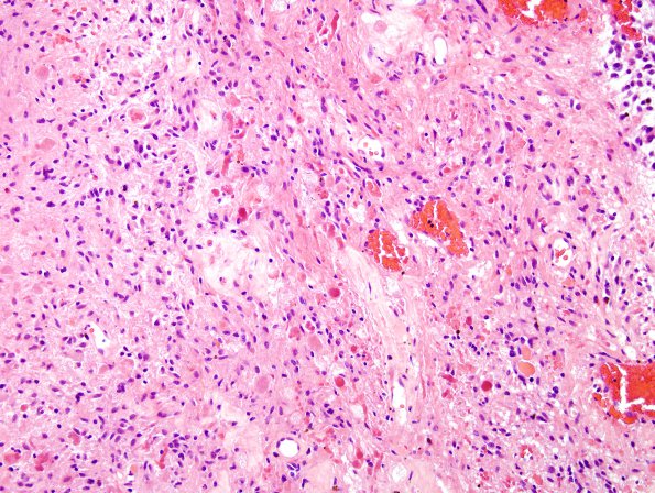 44B3 Astrocytoma, pilocytic (Case 44) H&E 2