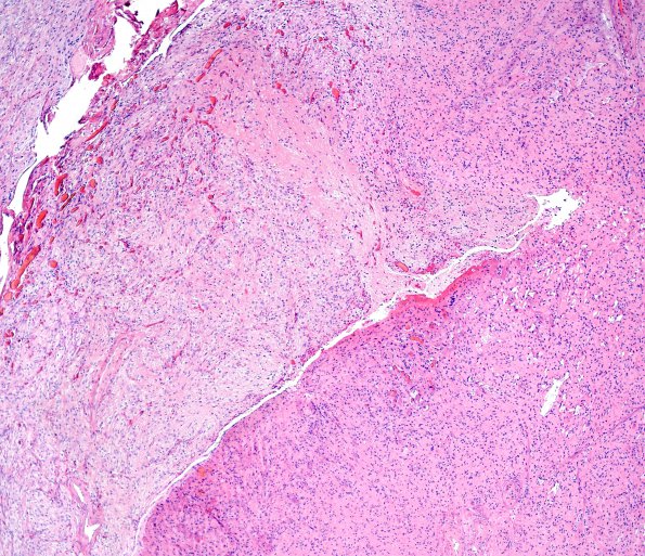 45A1 Astrocytoma, pilocytic (Case 45) H&E 8