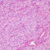 45A2 Astrocytoma, pilocytic (SAS infiltration, Case 45) H&E 1