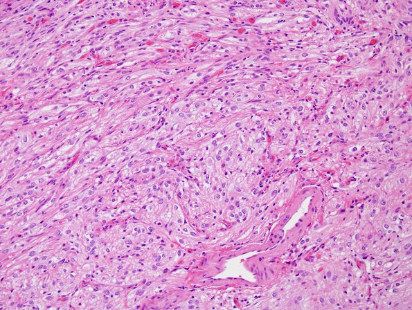 45A2 Astrocytoma, pilocytic (SAS infiltration, Case 45) H&E 1