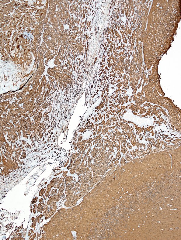 45B Astrocytoma, pilocytic (SAS infiltration, Case 45) GFAP 3