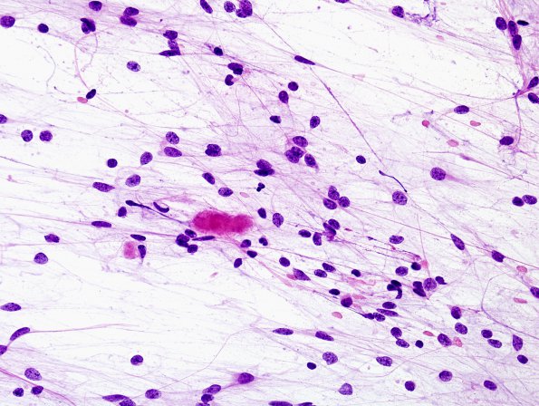 46A1 Astrocytoma, pilocytic (Case 46) Squash Prep H&E 1