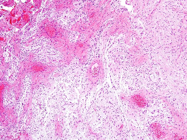 46A2 Astrocytoma, pilocytic (Case 46) H&E 16